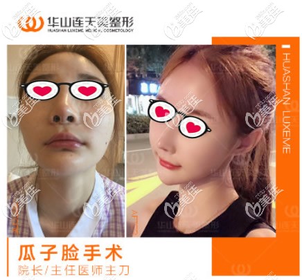 高俊明V-line瓜子臉整形前后對比照片 高俊明V-line瓜子臉整形前后對比照片