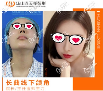 杭州華山連天高俊明長曲線下頜角截骨案例 杭州華山連天高俊明長曲線下頜角截骨案例