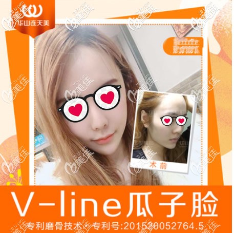 杭州華山連天美醫(yī)院高俊明院長輪廓三件套效果 杭州華山連天美醫(yī)院高俊明院長輪廓三件套效果