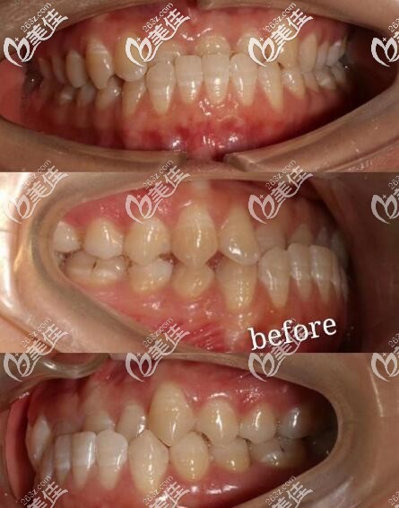 南京美奧口腔反頜地包天隱適美矯正案例 南京美奧口腔反頜地包天隱適美矯正案例