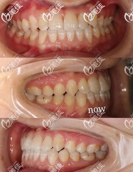 南京鼓樓美奧口腔隱適美隱形矯正反頜案例 南京鼓樓美奧口腔隱適美隱形矯正反頜案例