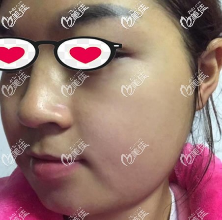 蘭州崔大夫整形面部吸脂前 蘭州崔大夫整形面部吸脂前