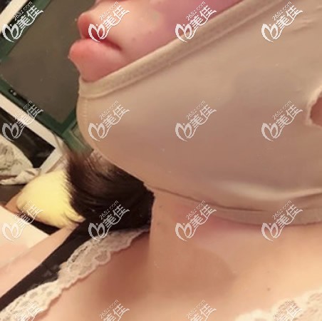 面部吸脂后帶頭套 面部吸脂后帶頭套