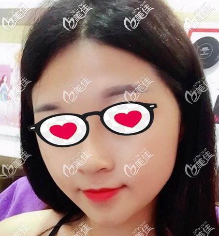 臉部抽脂三個(gè)月效果 臉部抽脂三個(gè)月效果