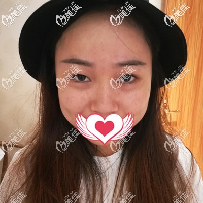 做皮秒祛斑前的我 做皮秒祛斑前的我