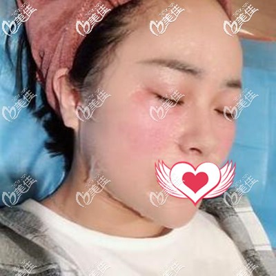 做皮秒術(shù)后即刻 做皮秒術(shù)后即刻