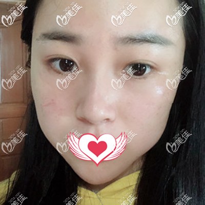 超皮秒術(shù)后3天效果 超皮秒術(shù)后3天效果