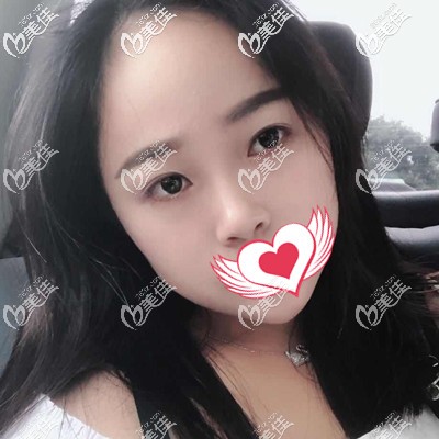 做完皮秒祛斑術(shù)后1個(gè)月效果 做完皮秒祛斑術(shù)后1個(gè)月效果