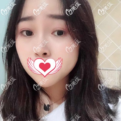 滿臉雀斑的敏感肌做皮秒激光祛斑90天變化過(guò)程圖，你要不要看？