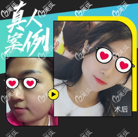 面部抽脂前后對(duì)比照片 面部抽脂前后對(duì)比照片