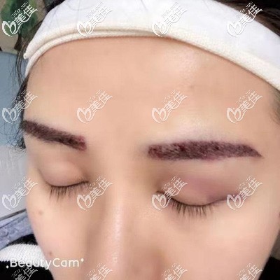 成都恒博毛發(fā)科植眉毛即刻效果