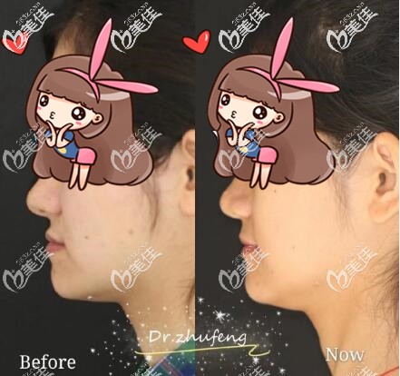 對比了南京正規(guī)牙科醫(yī)院的價格后,反頜地包天姑娘選擇在私立口腔做了隱適美矯正