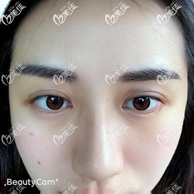 眉毛種植7天恢復(fù)效果