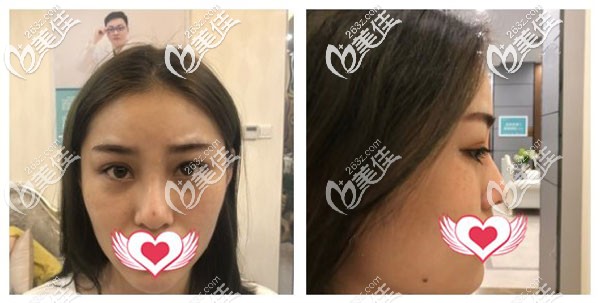 做鼻修復(fù)手術(shù)前 做鼻修復(fù)手術(shù)前