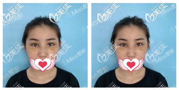 耳軟骨隆鼻第7天拆線眼周淤青還沒消退 耳軟骨隆鼻第7天拆線眼周淤青還沒消退