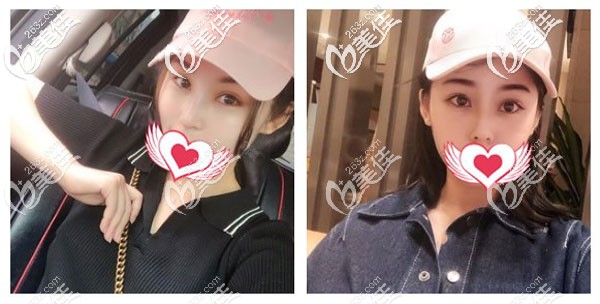 耳軟骨復(fù)合隆鼻已經(jīng)一個月疤痕摸著有點硬 耳軟骨復(fù)合隆鼻已經(jīng)一個月疤痕摸著有點硬