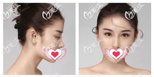 耳軟骨鼻綜合兩個月線條流暢 耳軟骨鼻綜合兩個月線條流暢