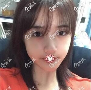 我在重慶軍科整形割完雙眼皮半個月了