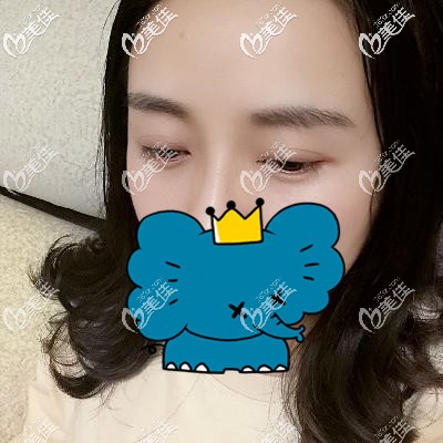 不管你想知道成都植眉毛哪里好還是植眉價格,看了我的眉毛種植經歷你就懂了