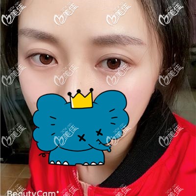 眉毛種植一個月進入脫落期