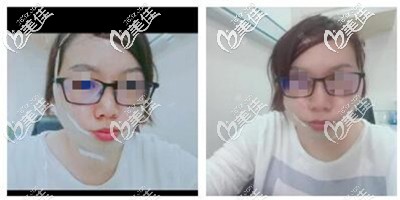 射頻溶脂后戴頭套