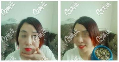 射頻溶脂術(shù)后半個(gè)月恢復(fù)效果