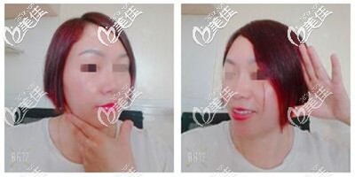 射頻溶脂瘦臉術(shù)后1個(gè)月恢復(fù)效果