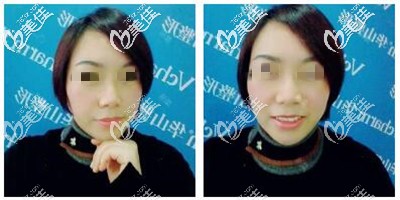 聊一聊我做完射頻溶脂瘦臉2個月沒反彈，對比之前照片臉還緊致了不少恢復效果