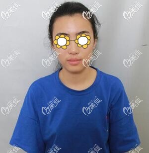 做假體隆胸術前照 做假體隆胸術前照