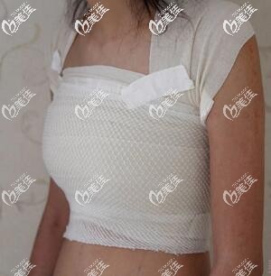 假體隆胸術后3天效果圖 假體隆胸術后3天效果圖