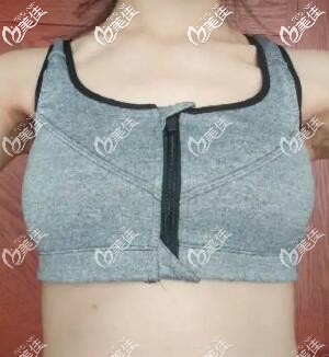 做假體隆胸術后25天效果圖 做假體隆胸術后25天效果圖