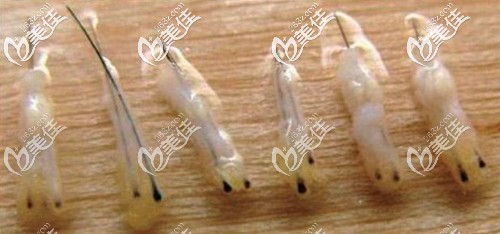 植發(fā)手術(shù)中提取的毛囊組織