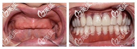 老爸種植全口牙前后效果對比照片