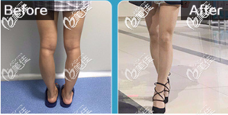 北京京民王志堅O(shè)X腿型矯正真人案例