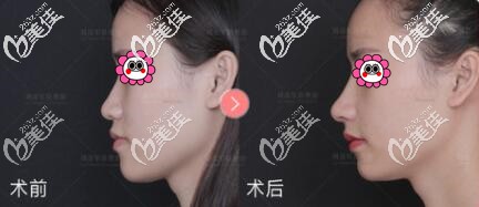 北京沃爾劉彥軍假體隆鼻真人前后對(duì)比效果照 北京沃爾劉彥軍假體隆鼻真人前后對(duì)比效果照