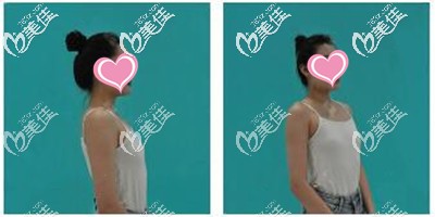 假體隆胸手術(shù)前 假體隆胸手術(shù)前