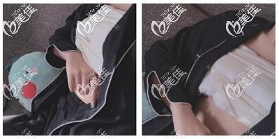 假體隆胸手術(shù)后第四天 假體隆胸手術(shù)后第四天