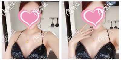 假體隆胸術(shù)后拆線 假體隆胸術(shù)后拆線