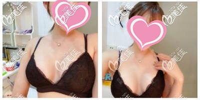 假體隆胸手術(shù)后一個(gè)月恢復(fù)效果 假體隆胸手術(shù)后一個(gè)月恢復(fù)效果