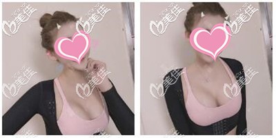 奉上平胸做了假體300cc隆胸手后效果圖，也不算大的很夸張