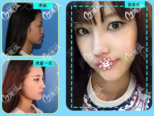 羅志敏肋軟骨隆鼻案例 羅志敏肋軟骨隆鼻案例