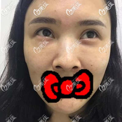 自體脂肪填充淚溝術(shù)前照 自體脂肪填充淚溝術(shù)前照