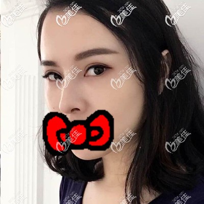 填淚溝術(shù)后1個月照片 填淚溝術(shù)后1個月照片