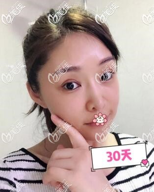 重慶美萊埋線提升術(shù)后一個(gè)月