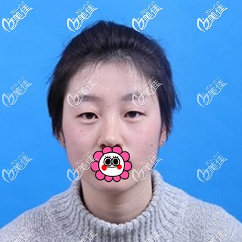 做貝塞爾雙眼皮術(shù)前照 做貝塞爾雙眼皮術(shù)前照