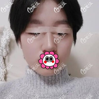 體驗貝塞爾雙眼皮術(shù)后2天照 體驗貝塞爾雙眼皮術(shù)后2天照