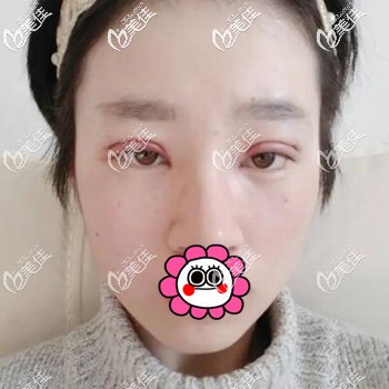 做貝塞爾雙眼皮術(shù)后3天照片 做貝塞爾雙眼皮術(shù)后3天照片
