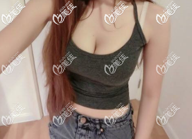 西安高一生自體脂肪隆胸術(shù)后兩個月的樣子