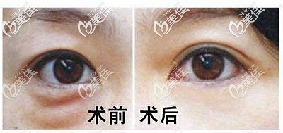 內(nèi)切去眼袋后的效果對比