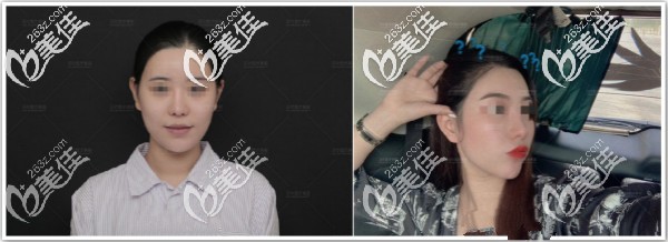 北京沃爾劉彥軍鼻修復(fù)真實(shí)案例